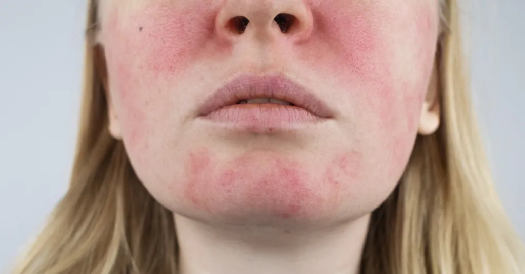 Alcohol Abuse and Red Face