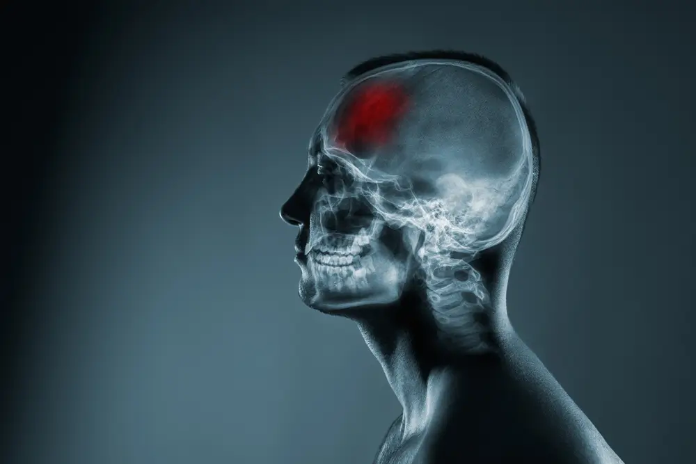 Understanding Toxic Brain Damage