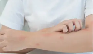 Signs of an Allergic Reaction to Meth